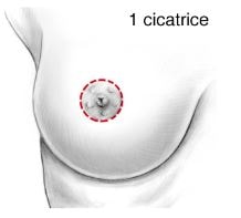 lifting seins ptôse mammaire minime