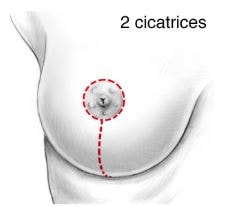 lifting seins ptôse mammaire modérée