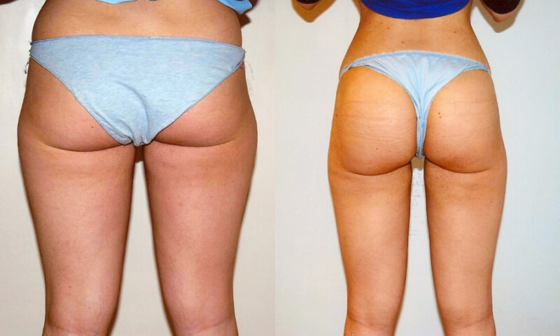 liposuccion jambes avant apres