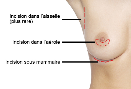 choix cicatrices augmentation mammaire